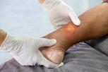 Cara Menyembuhkan Koreng di Kaki dengan Mudah